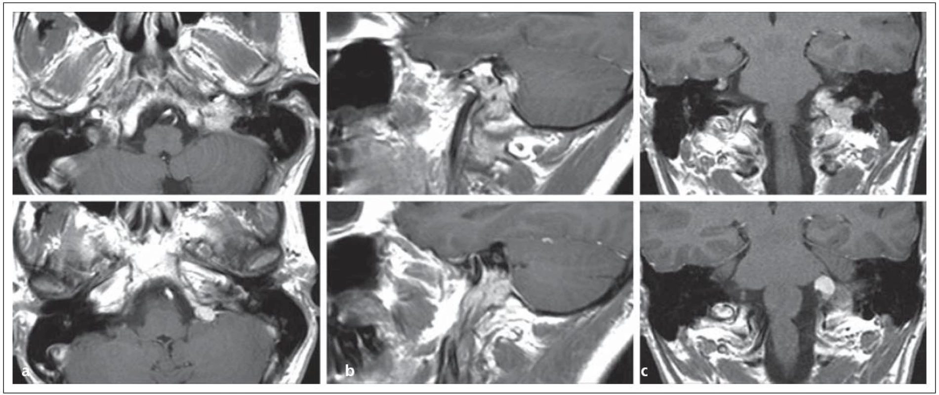 Glomus jugulare tumor sutkovitého tvaru s propagací extrakraniálně i intrakraniálně v MR zobrazení v a) transverzální, b) sagitální, c) koronární rovině.