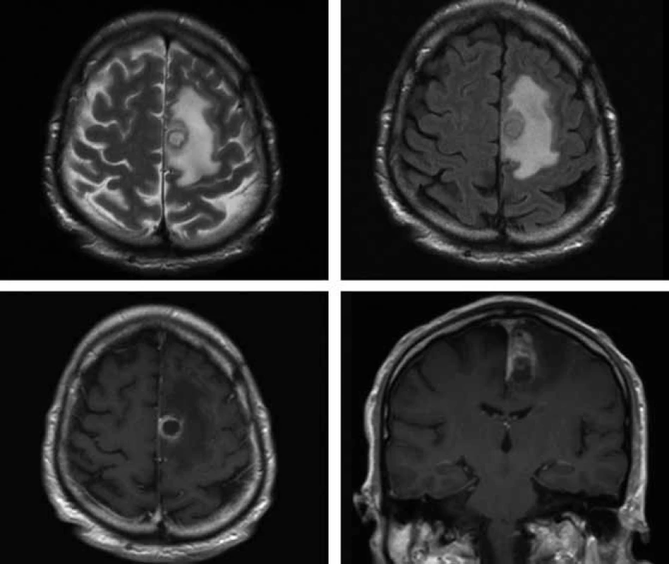 Vstupní MR vyšetření mozku ze dne 17. 10. 2009 (v horním řádku vlevo T2 vážený obraz, vpravo T2 vážený obraz v sekvenci FLAIR, v dolním řádku postkontrastní T1 vážené obrazy v axiální a koronární orientaci) – nepravidelně prsténčitě se opacifikující ložisko s perifokálním edémem vlevo v precentrální oblasti.
