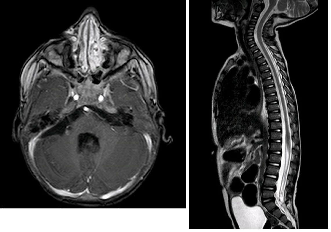 A, B: Na kontrolním MRI cerebrospinální osy 7 měsíců od primární resekce je patrná jasná regrese primárního ložiska včetně všech metastatickým lézí
Image 6 A,B: Follow-up MRI after 7 months since primary resection showing regression of both primary lesion and metastatic foci.