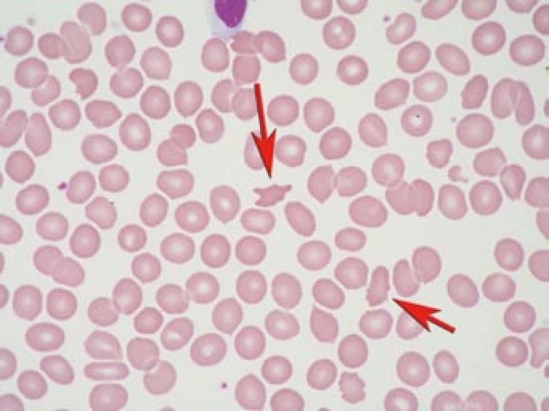 Akantocyty v krevním nátěru.
