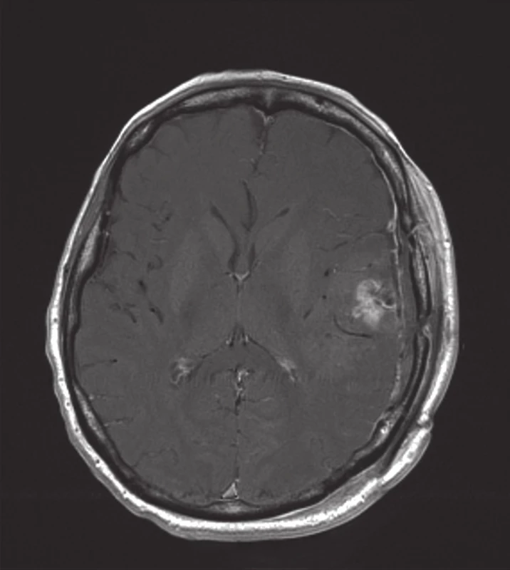 Po operační enhancující reziduum anaplastického oligodendrogliomu (MRI: T1 vážený obraz po podání gadolinia).