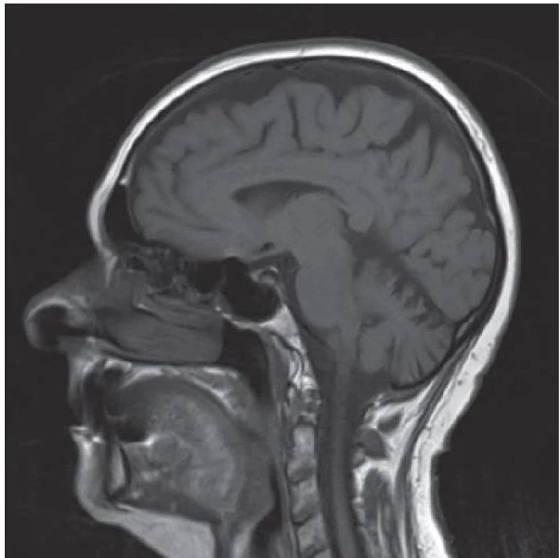 MR mozku se zachycenou atrofií mozku a mozečku.