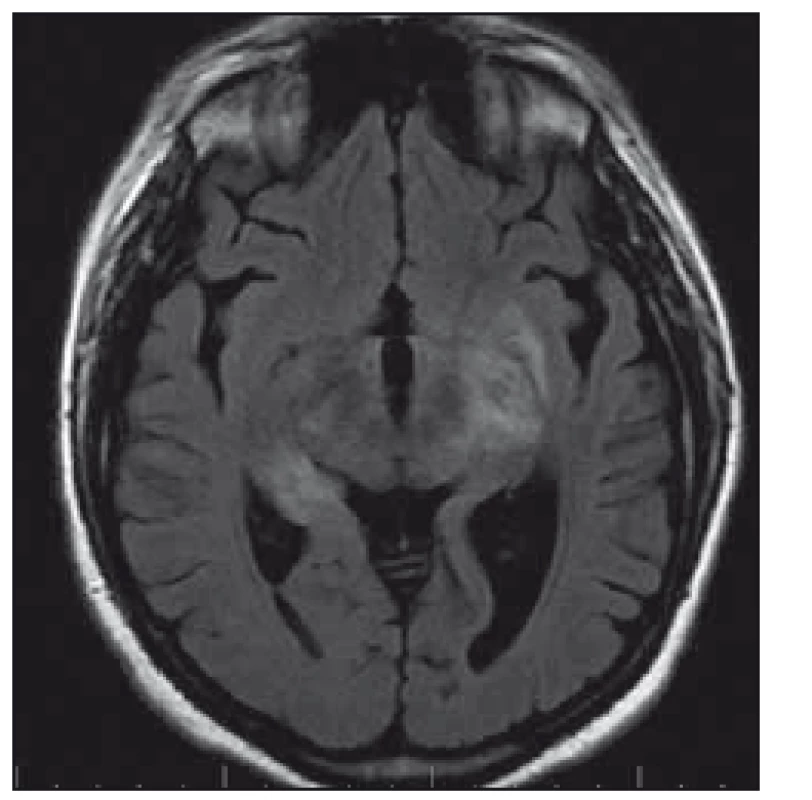 Pacientka 3 – MR nález encefalitidy v oblasti limbického systému a obou kapsul.
Fig. 2. Patient 3 – MRI of of encephalitis in the limbic system and both capsules.