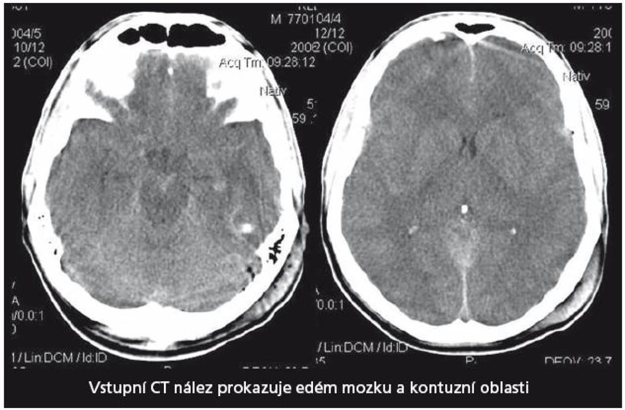 Vstupní CT vyšetření mozku u pacienta 1. Prokazuje naznačené mnohočetné kontuze a edém mozku.