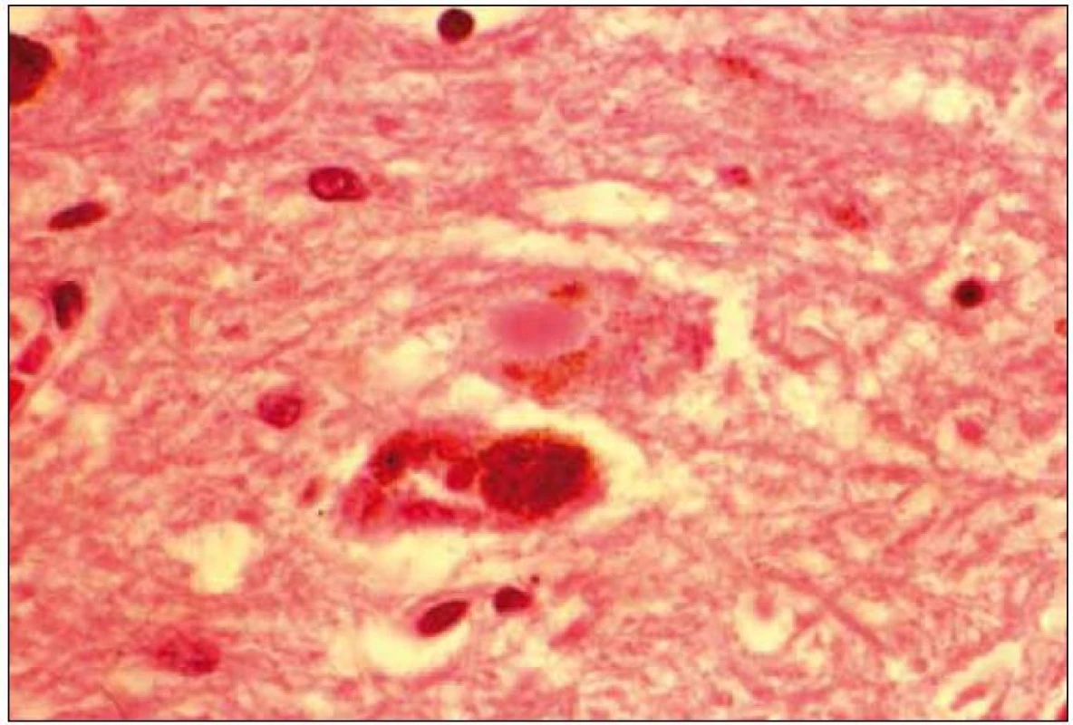 „Lewy body“ v cytoplazmě neuronu z oblasti substantia nigra.
Barvení hematoxilin eozin.