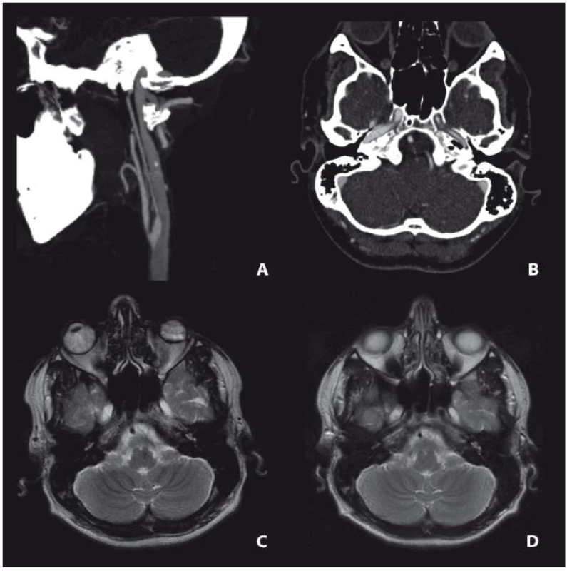 Třicetiletý pacient se suspektním nálezem levostranné hypoplazie ACI na extrakraniální CT angiografii (A), avšak s normální velikostí karotického kanálu v temporální kosti (B). MR v souhlasu s ultrazvukem potvrdila zánětlivé zesílení stěny tepny při vaskulitidě (C). Revidované MR (D) provedené při první tranzitorní ischemické
atace potvrdilo získanou stenózu vnitřní karotidy.