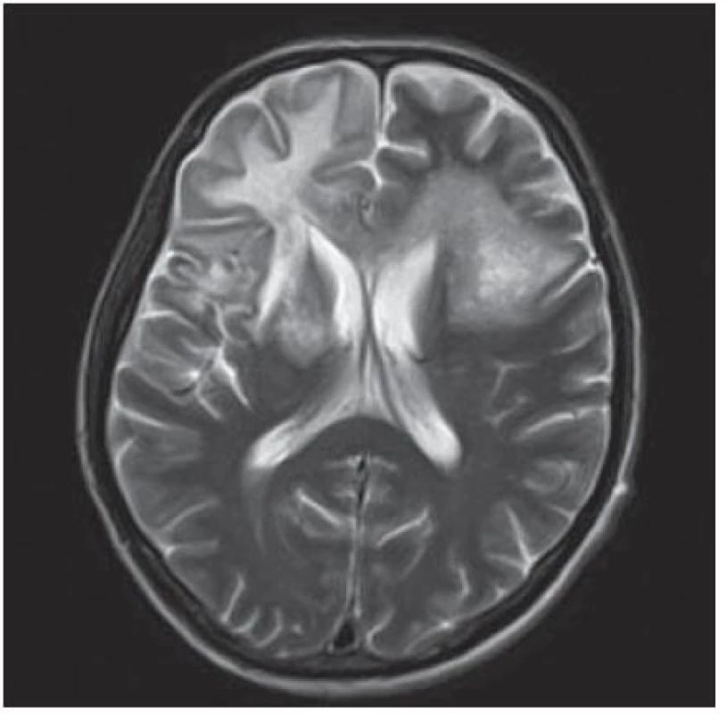 Masivní postižení bílé hmoty frontotemporálně subkortikálně, dále bazálních ganglií, vpravo v capsula interna a oboustranně periventrikulárně, které se projevuje vysokým signálem v T2W sekvenci MR zobrazení.