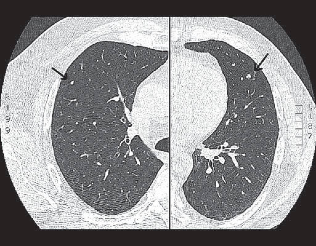 HRCT plic popisovaného případu nemocného se sarkoidózou (vyšetření z ledna 2009).
Fig. 1. HRCT of lungs of reported patient with sarcoidosis (January 2009).
