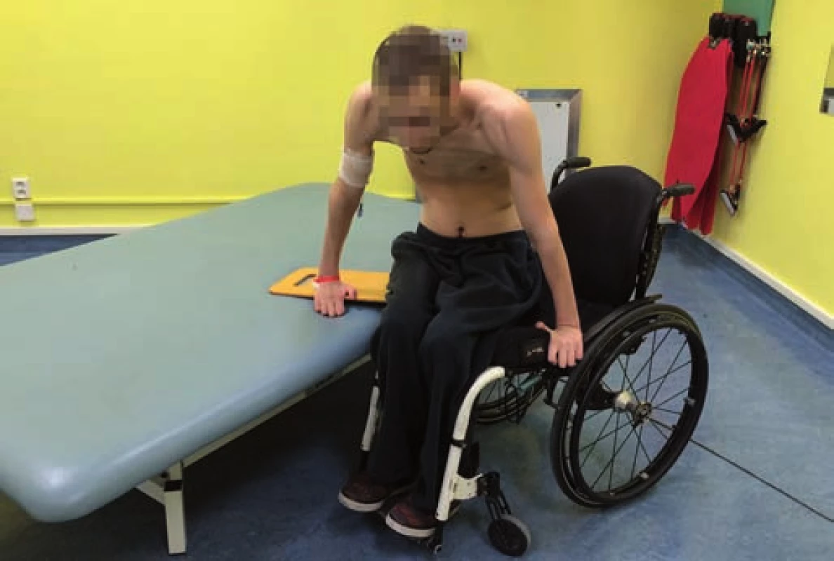 Samostatný přesun pacienta s míšní lézí C6 z vozíku na lůžko s využitím skluzné desky.
Fig. 6. Unassisted transfer of a patient with the C6 spinal lesion from a wheelchair to a bed using a transfer board.