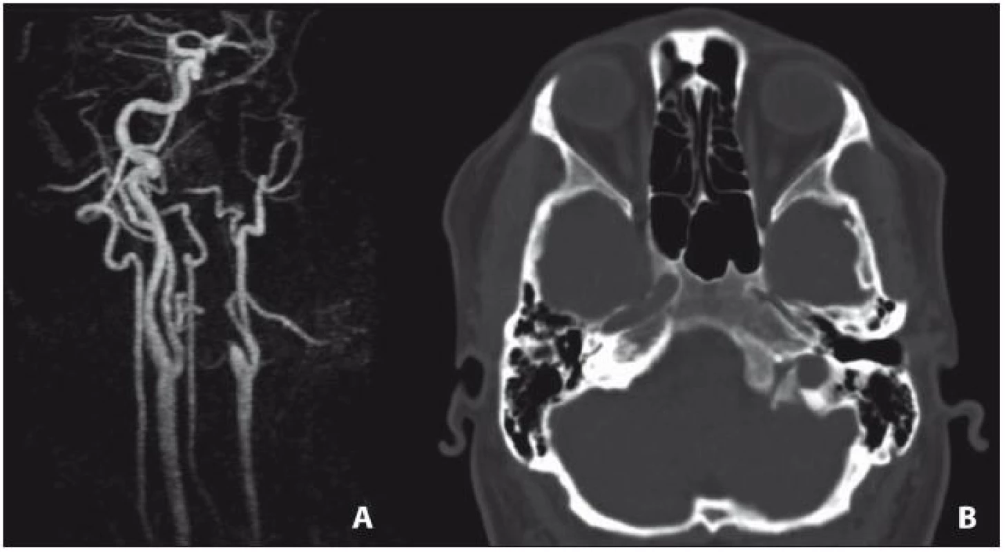 CT obraz levostranného hypoplastického karotického kanálu (B) a pahýl levé ACI na MR angiografii (A).
