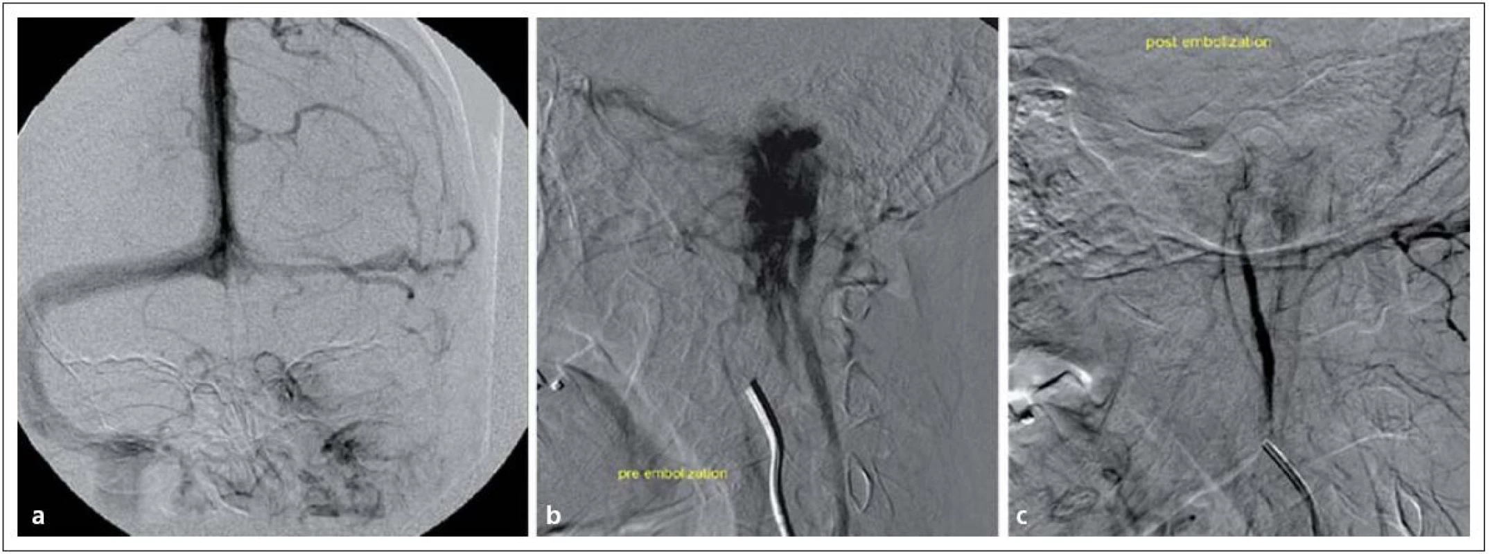Tumor glomus jugulare vlevo v zobrazení DSA.
Obr. 9a) Obliterace sinus sigmoideus vlevo.
Obr. 9b) Extrémní hypervaskularizace tumoru glomus jugulare.
Obr. 9c) Příznivý stav po embolizaci nádoru.