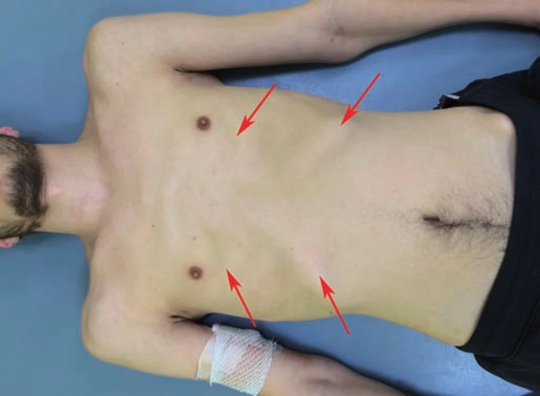 Hrudník pacienta s míšní lézí C6.
Vpadlé mezižeberní prostory kvůli plegickým a atrofickým interkostálním svalům. Prominence dolních žeber při ztrátě fixace plegickou břišní stěnou. Zvýšené napětí pomocných nádechových svalů (m. trapezius, m. sternocleidomastoideus).
Fig. 1. Patient’s chest with C6 spinal cord lesion.
Sunken intercostal space due to plegic and atrophic intercostal muscles. Prominence of the lower ribs due to loss of fixation by the plegic abdominal wall. Increased muscle tone of the auxiliary inspiratory muscles (m. trapezius, m. sternocleidomastoideus).