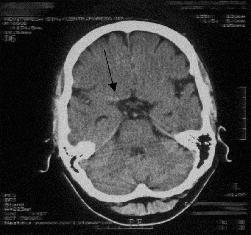 Obraz hyperdenzní a. cerebri media vpravo (šipka) – vstupní CT obraz u pacienta IV.
