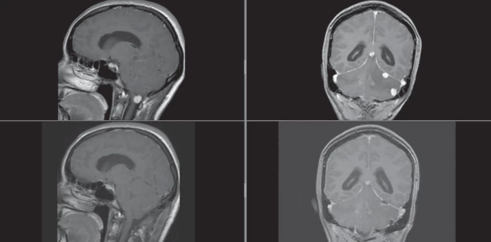 Postkontrastní zobrazení MR mozku před první akutní operací pacientky. (A) Na sagitálním řezu hemangioblastom s kompresí medula oblongata; (B) na koronárním řezu dvě ložiska v oblasti levé mozečkové hemisféry s perifokálním edémem. Ve spodní části zachyceny identické řezy na pooperační kontrole pacientky.
