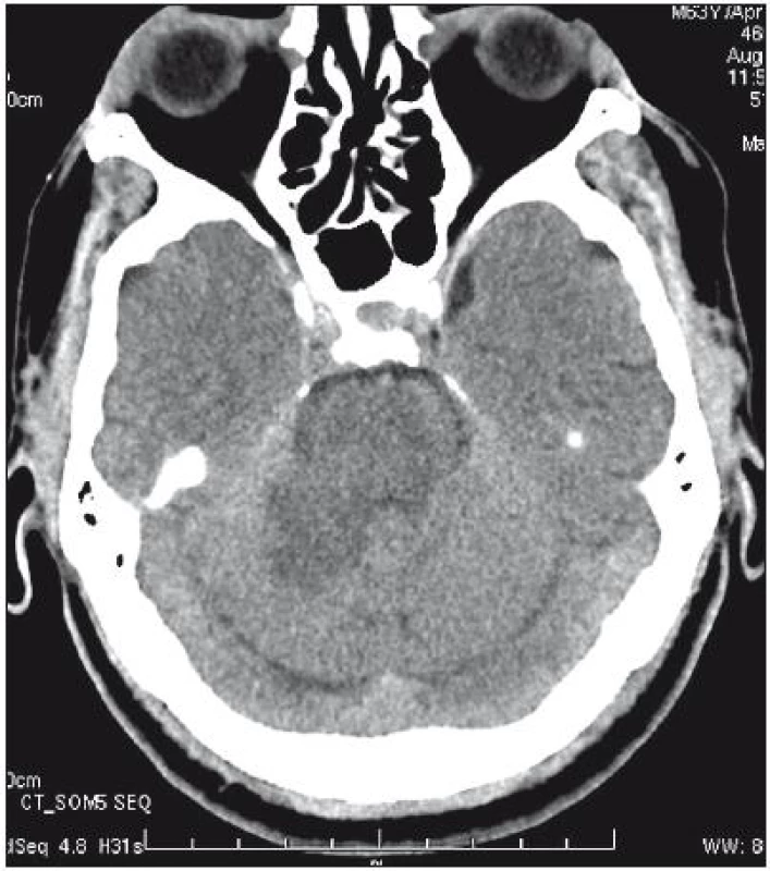 Kontrolní CT sken den po endovaskulárním výkonu ukazující ischemii v oblasti pontu a v mozečkové hemisféře vpravo.