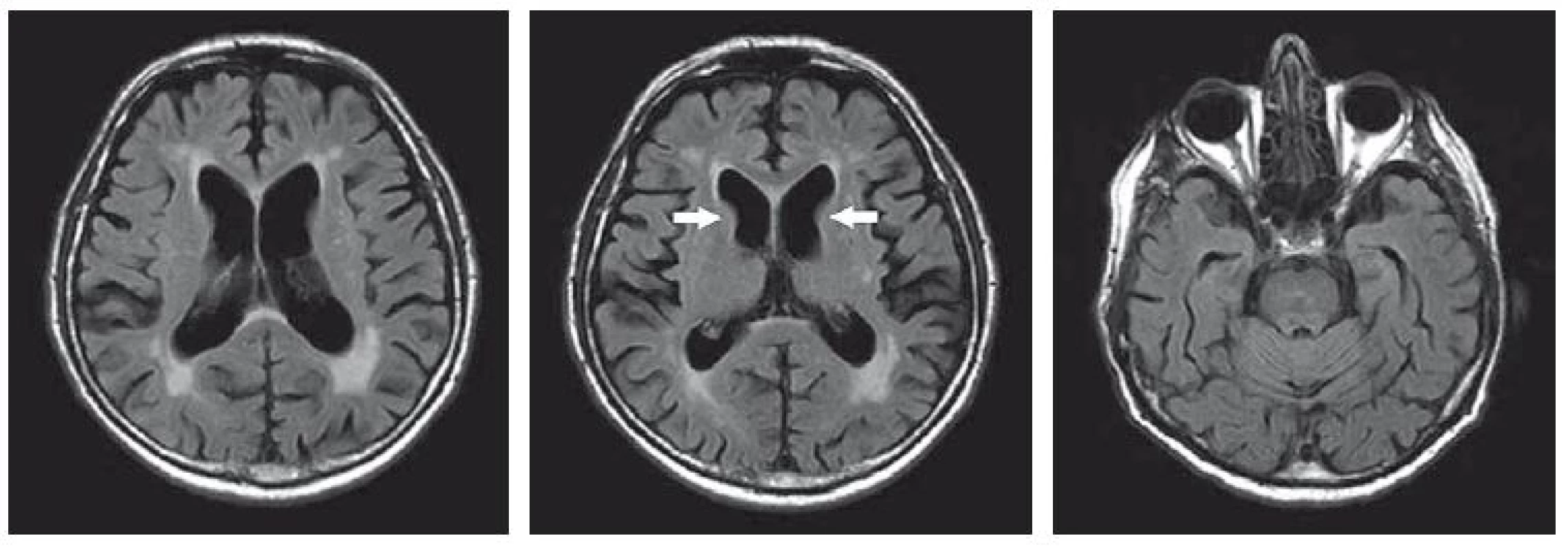 MR mozku z roku 2016, FLAIR. Leukoaraióza a drobné ischemické lakuny v bazálních gangliích oboustranně, atrofie mozku kortikosubkortikální, atrofie caput nuclei caudati oboustranně (označeno šipkami). <br>Fig. 2. MRI brain scan from 2016, FLAIR. Leucoaraiosis and small post-ischemic lacunes in bilateral basal ganglia, corticosubcortical brain atrophy, bilateral atrophy of the caudate nucleus (arrows).