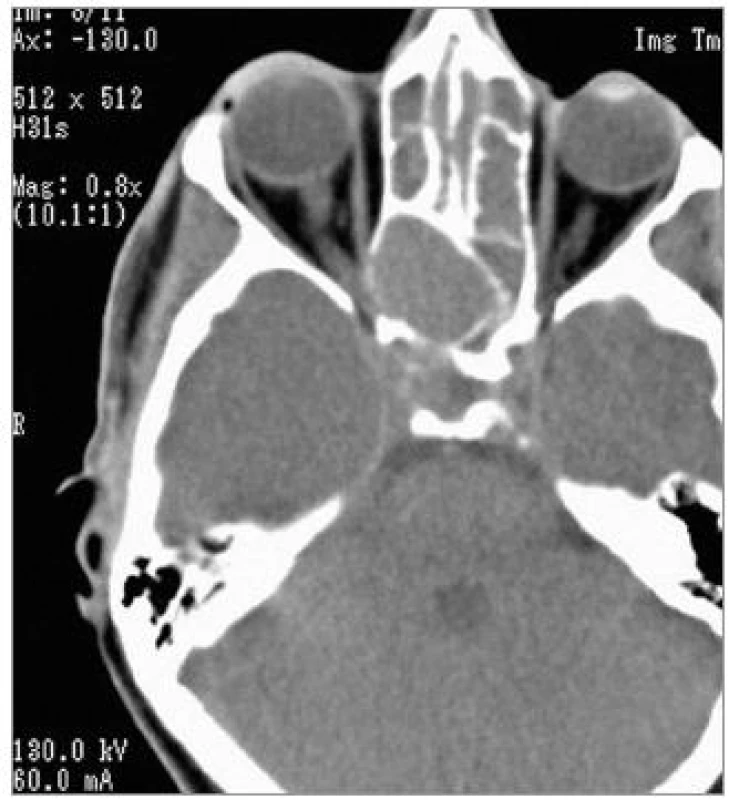 Axiální CT – zastření etmoidů a klínové dutiny oboustranně, expanzivně se chovající mukokéla v oblasti zadních čichových sklípků a klínové dutiny vpravo.