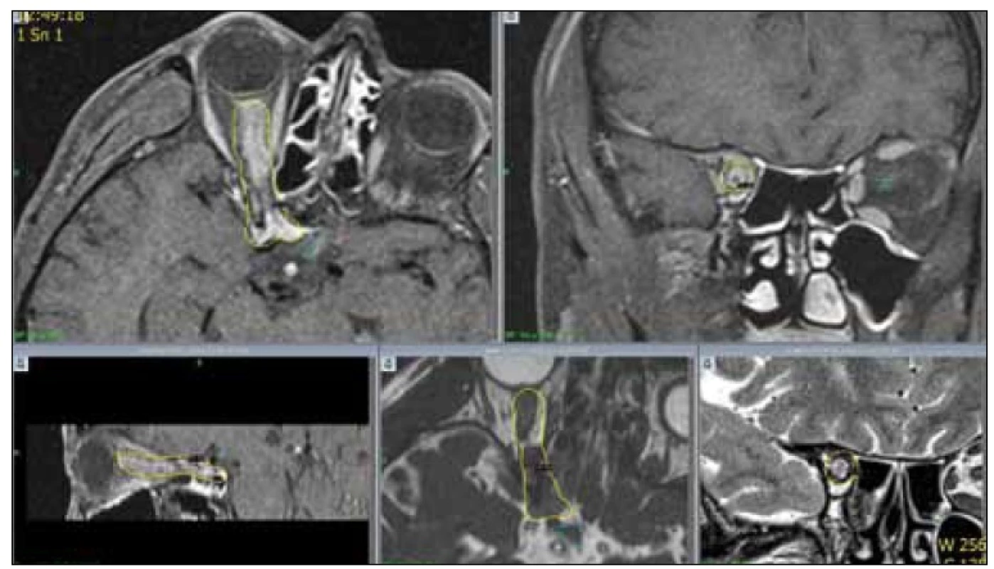 MR pravé orbity, T1 vážený obraz, postkontrastní snímky u 53leté pacientky s meningeomem pochvy optického nervu před plánovanou léčbou na gama noži. Žlutou linií je označena oblast plánovaného ozáření (meningeom a n. opticus), dávka na okraj 13 Gy. Klinicky amauróza.