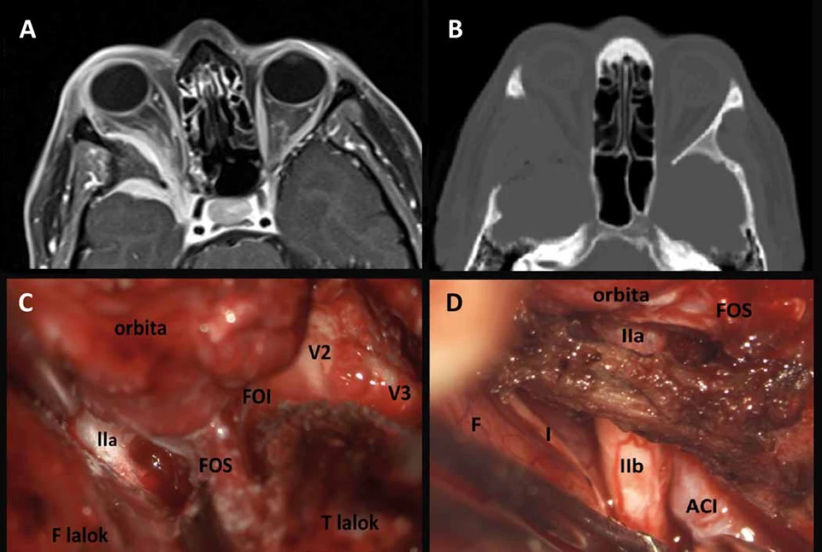 Sphenoorbitální meningeom vpravo před operací (A) a po radikální resekci (B), intraoperační fotografie (C, D) ukazují rozsah resekce infiltrované kosti.
