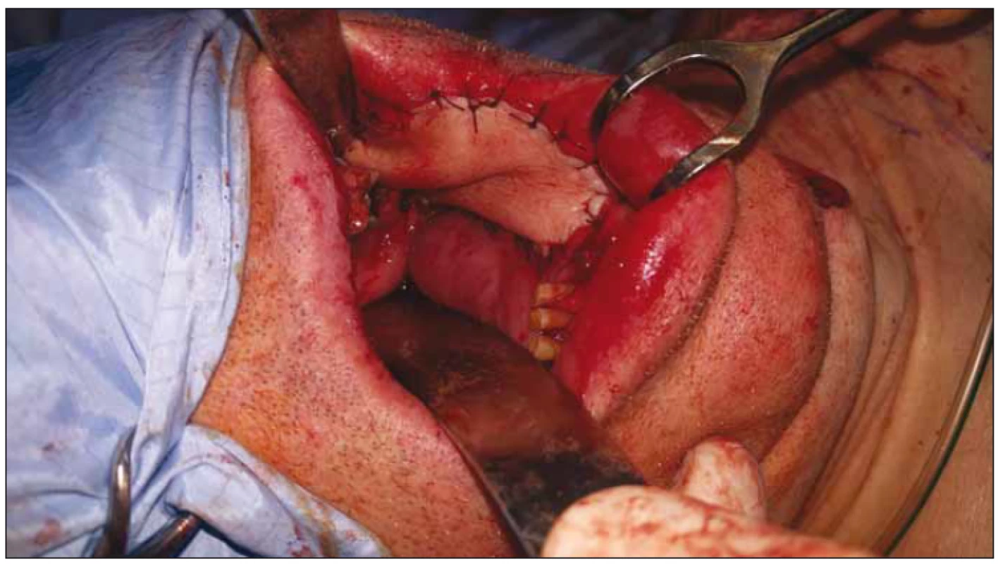 Lalok fixován do defektu (pacient č. 1).<br>
Fig. 4. Placement of the flap in the intraoral defect (patient No. 1).