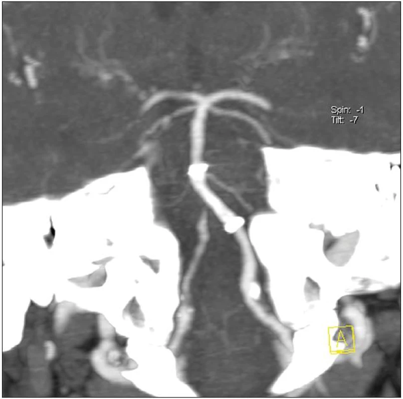 Kontrolní CT angiografie, v MIP obraze je dobře patrna normální průchodnost basilární tepny včetně stentovaného úseku a normální plnění tepen zadní jámy lební. Současně je dobře patrna reziduální těsná stenóza vertebrální tepny vpravo.