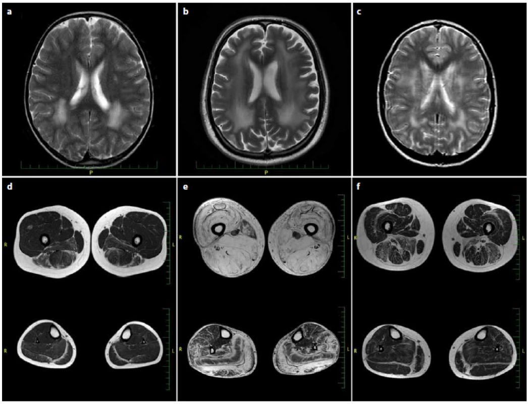 MR mozku v T2 obrazech axiálně (a–c), MR svalů dolních končetin (stehna nahoře, lýtka dole) v T1 obrazech axiálně (d–f).
Fig. 1. Brain T2 axial MRI (a–c), T1 axial MRI of lower limb muscles (thighs on the top, calf below) (d–f).