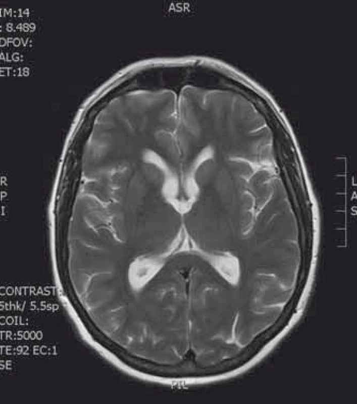 Kontrolní vyšetření po 6 měsících od radikální mikroskopické exstirpace.
Fig. 7. Follow-up MRI 6 month after the surgery with no residual colloid cyst.