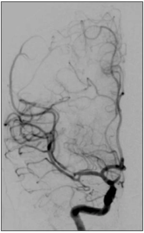 Kontrolní angiografie s obnovením průtoku lentikulostriátních tepen a parietookcipitální větve cerebri media.
V úrovni M2 je patrný vazospazmus vzniklý po manipulaci se stentem.
