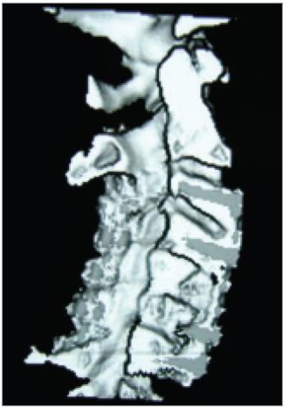 Prostorový (3D) CT-obraz páteřního kanálu po laminektomii C3/5 a instrumentované rekonstrukci předního sloupce pro deformitu vzniklou po 2 operacích pro CDDD z předního přístupu.
