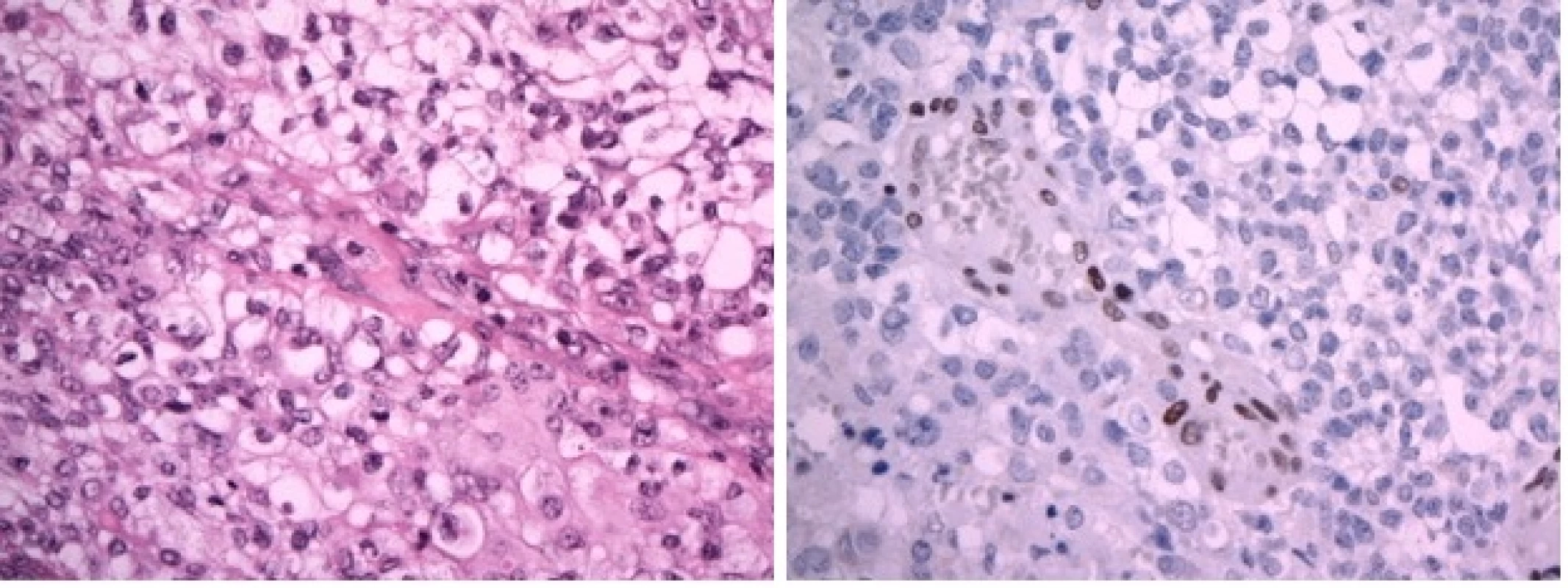 A Atypický teratoidní/rhabdoidní tumor (AT/RT), WHO grade IV. Nádor převážně sestává ze solidně alveolárně uspořádaných polygonálních buněk se světlou nebo jemně eozinofilní cytoplazmou. Fokálně jsou přítomny výrazné atypie, proliferační aktivita byla vysoká. (hematoxylin-eozin, originální zvětšení x400).
B Imunohistochemický průkaz proteinu INI1 je v nádorových buňkách negativní (při pozitivní vnitřní kontrole v endoteliích, originální zvětšení x400).
Image 4 A: Atypical teratoid-rhabdoid tumor (AT/RT), WHO grade IV. Polygonal cells with pale or slightly eosinophilic cytoplasm arranged in alveolar pattern. High proliferation aktivity. (H&amp;E x400)
Image 4 B: Imunohistochemical negativity of INI1 protein in tumour cells (retained positivity in endothelial cells, x400)