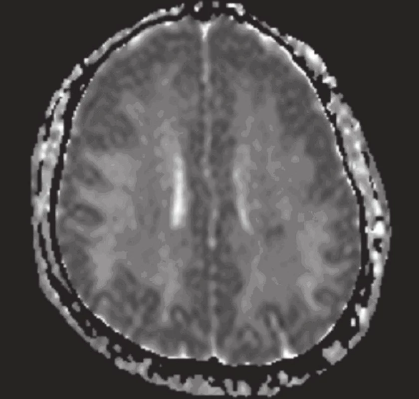 MR mozku: difuzně vážený obraz (tři dny po vzestupu TK): obr. 4a bez hrubších abnormalit, pouze diskrétní zvýšení signálu oboustranně okcipitálně, které lze vysvětlit „T2 shine through“ efektem, neznamená restrikci difuze. Tuto skutečnost potvrzuje ADC mapa (obr. 4b), kde jsou patrné plošné hyperintenzity představující facilitaci difuze při vazogenním edému. Absence restrikce difuze (cytotoxického edému) je u diagnózy hypertenzní encefalopatie dobrou prognostickou známkou ve smyslu možné reverzibility nálezu.
