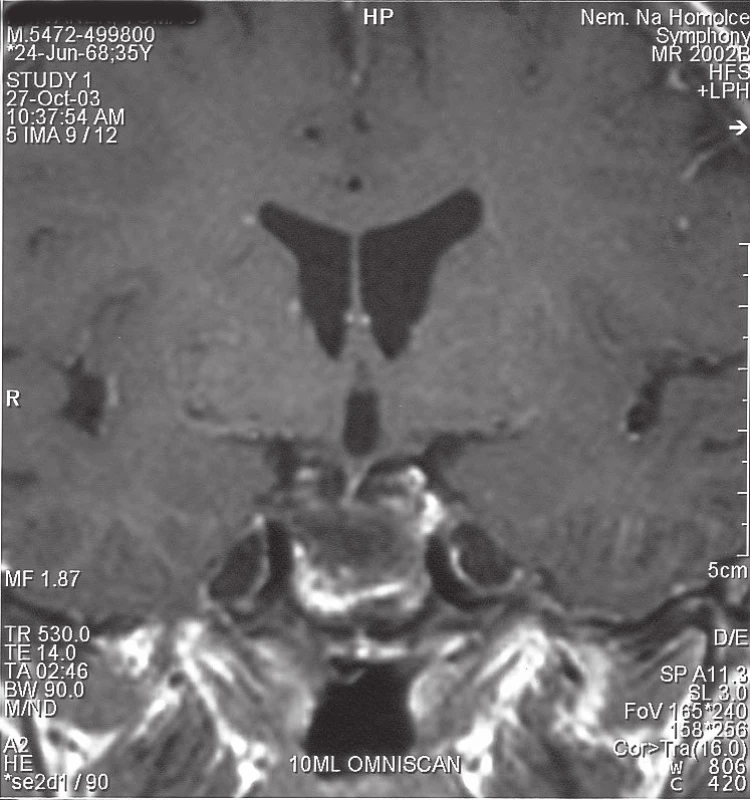 MRI (nekontrastní T1W obraz) na axiálním řezu zobrazuje utlačené kořeny kaudy ventrolaterálně doleva objemným intradurálním sekvestrem disku L2/3, který téměř vyplňuje páteřní kanál.
