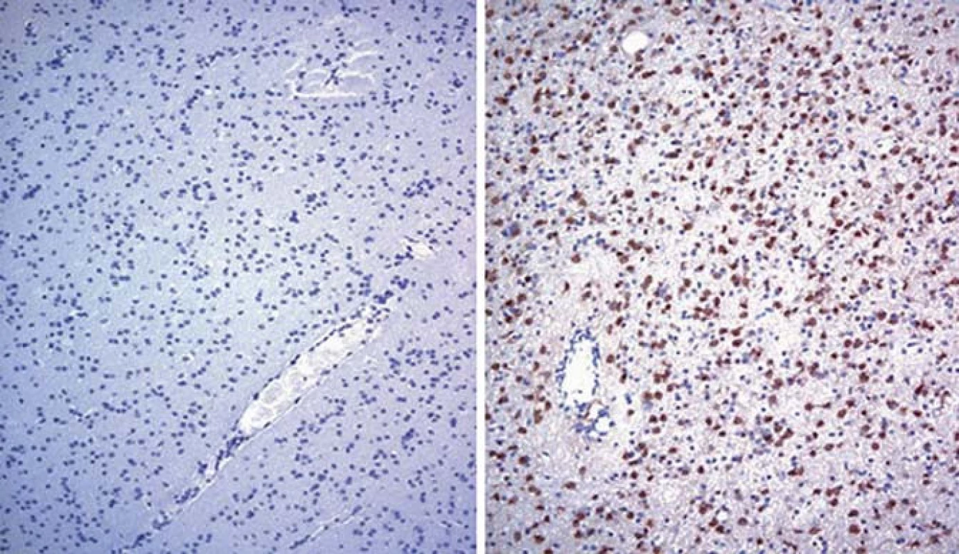 Imunohistochemická detekce buněk astrocytomu grade III pozitivních na IDH1-R132H mutaci (vpravo) a vzorku nádoru bez této mutace pro srovnání (vlevo). Převzato z [21].