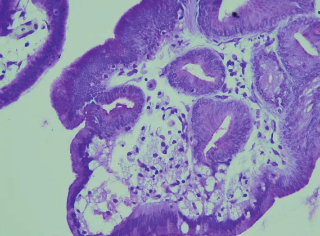 Histopatologické vyšetření.
Tubulopapilární adenom v barvení kresylvioletí.
Fig. 5. Histopathological examination.
Cresyl violet-stained tubulopapillary adenoma