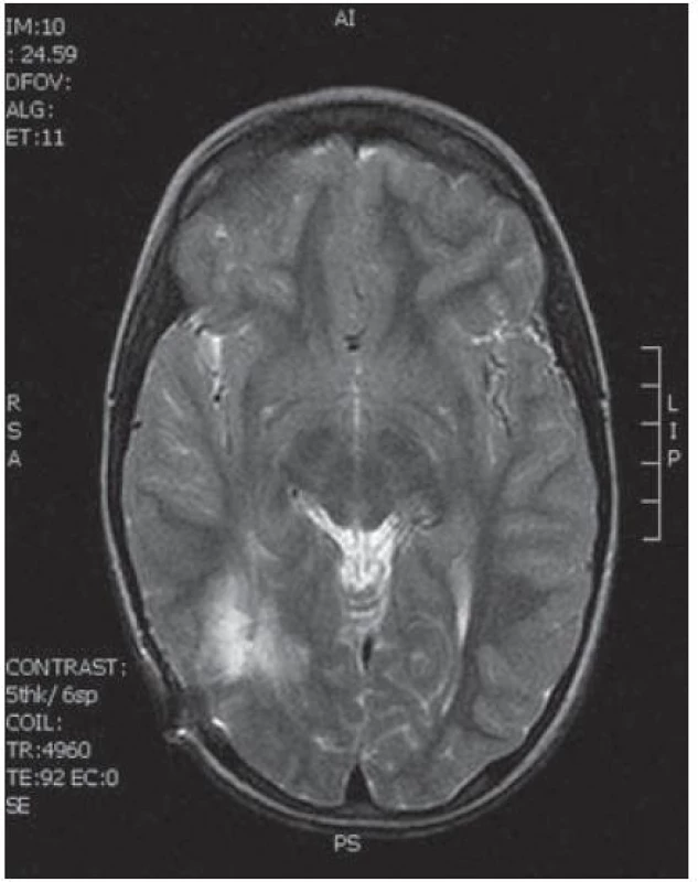 Pooperační MR T2 zobrazení tři měsíce po výkonu bez rezidua tumoru.