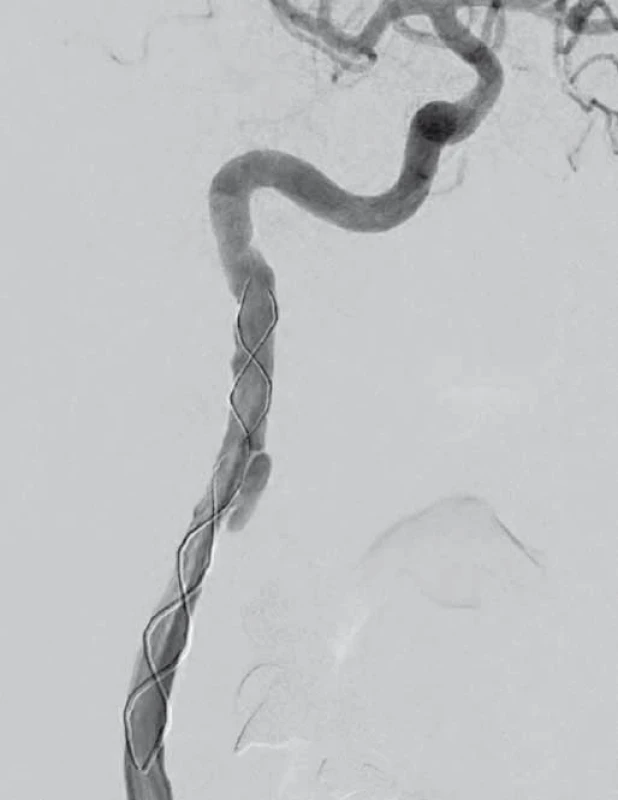 Digitální subtrakční angiografie.
Pravá a. carotis interna po endovaskulární léčbě.
Fig. 4. Digital subtraction angiography.
Right internal carotid artery after endovascular treatment.