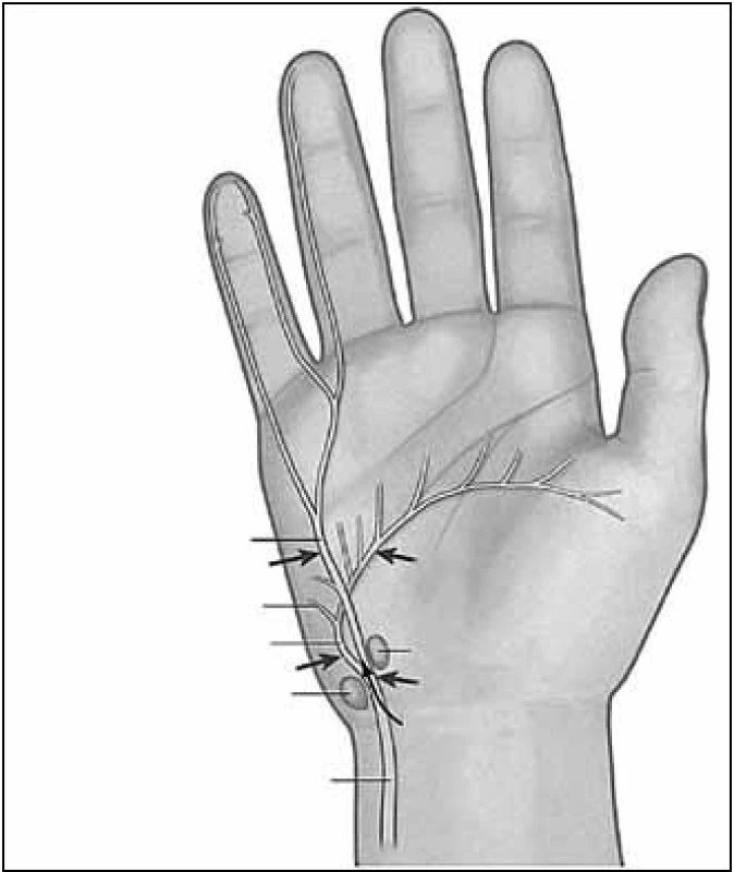 Průběh n. ulnaris v oblasti zápěstí a ruky [1].
Fig. 4. The course of the ulnar nerve in the region of the wrist and hand [1].
