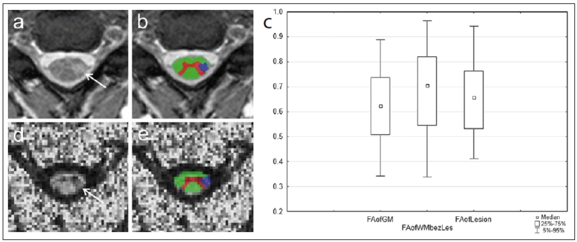 MR vyšetření u pacienta s roztroušenou sklerózou s hyperintenzním míšním ložiskem patrným na axiálním T2 váženém obraze gradientního echa (šipka na panelu a). Léze je sledovatelná i v obraze zobrazení tenzorů difuze v podobě snížení intenzity signálu na mapě frakční anizotropie (FA) (d).
Fig. 7. MRI examination in a patient with multiple sclerosis with a hyperintense spinal cord plaque apparent on the axial T2-weighted image of gradient echo (arrow on panel a). The lesion is perceptible also in the diffusion tensor imaging image in the form of reduced signal intensity on the fractional anisotropy (FA) map (d).