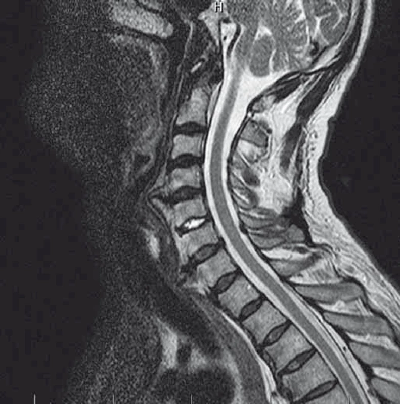 Předoperační MR, sagitální snímek (kazuistika 2).
Fig. 6. Preoperative MRI, sagittal image (a case report 2).