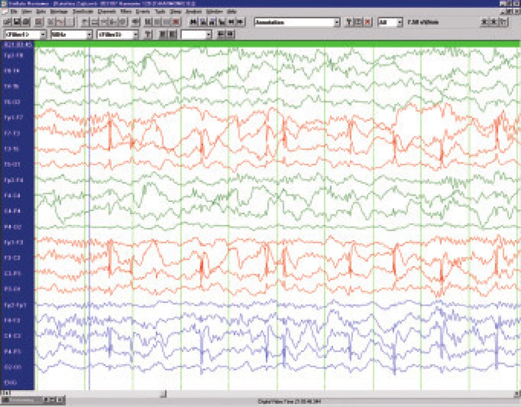 Benigní epilepsie s rolandickými hroty – interiktální EEG u 8letého chlapce.
