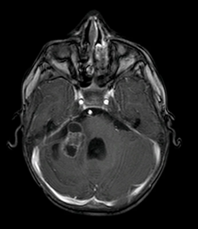 MRI prokazatelná recidiva tumoru v mostomozečkovém úhlu vpravo
Image 7: Reccurence of tumor in right cerebellopontine angle