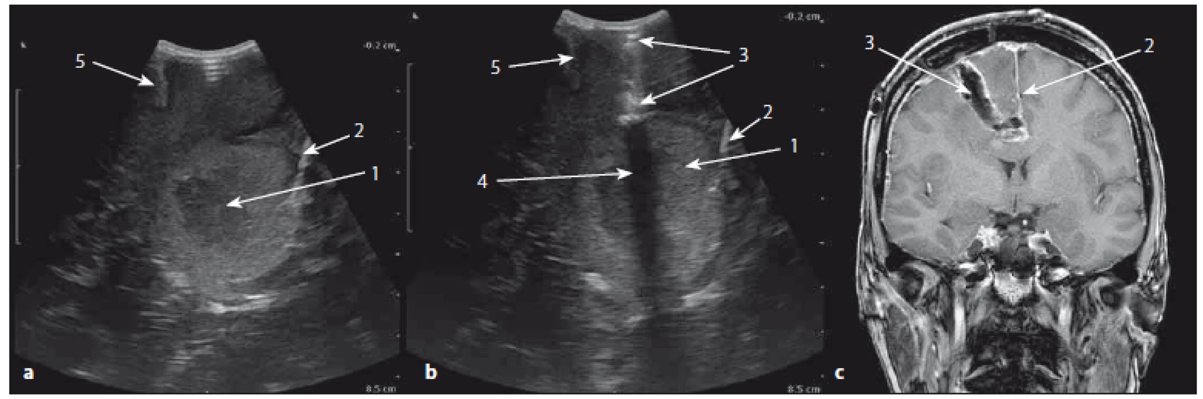 Sonografický peroperační obraz přístupové cesty a korespondující pooperační MR koronární řez v T1W obraze.
Fig. 3. The ultrasound image of the surgical approach and corresponding postoperative MRI T1W image in coronal section.