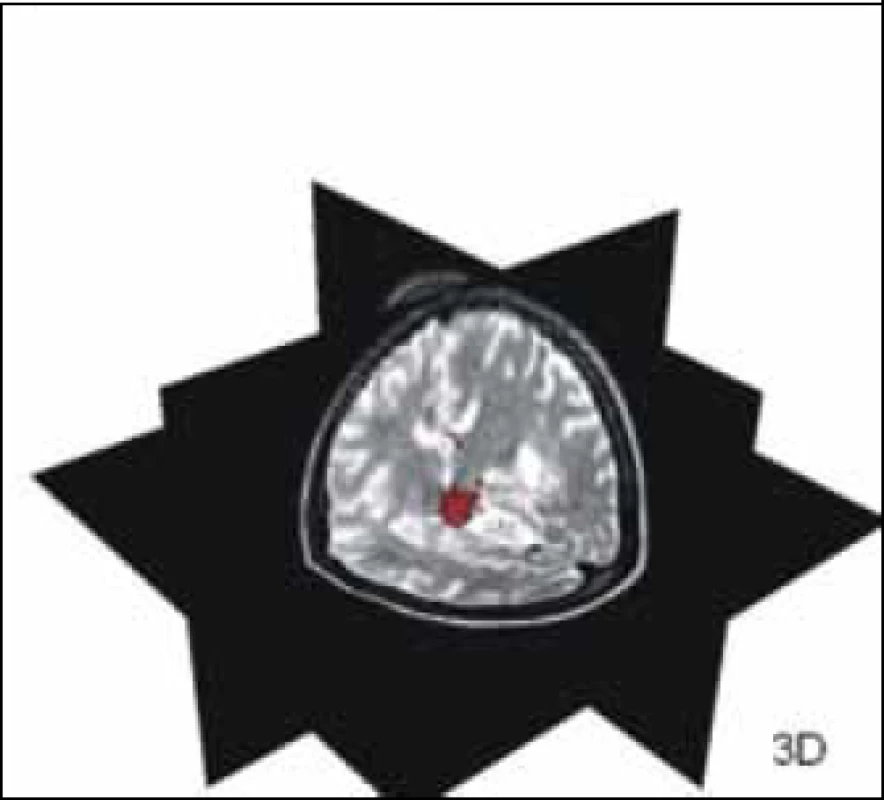 Červeně označená léze roztroušené sklerózy v různých MR sekvencích a jejich hodnocení pomocí programu SepINRIA (SepINRIA je volně dostupný software určený k analýze MR mozku pacientů s roztroušenou sklerózou s možností 2D a 3D zobrazení, kvantitativního manuálního či automatického hodnocení objemu a počtu lézí) [20].