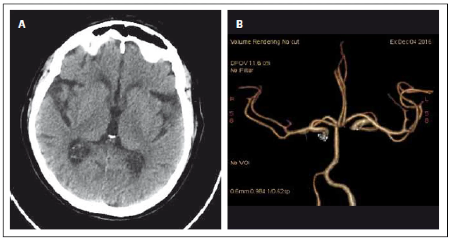 CT mozku při přijetí.
Obr. 1A) Nativ.
Obr. 1B) CT angiografie (Volume Rendering Technique).
Fig. 1. Brain CT on admission
Fig. 1A) Unenhanced.
Fig. 1B) CT angiography (Volume Rendering Technique).
