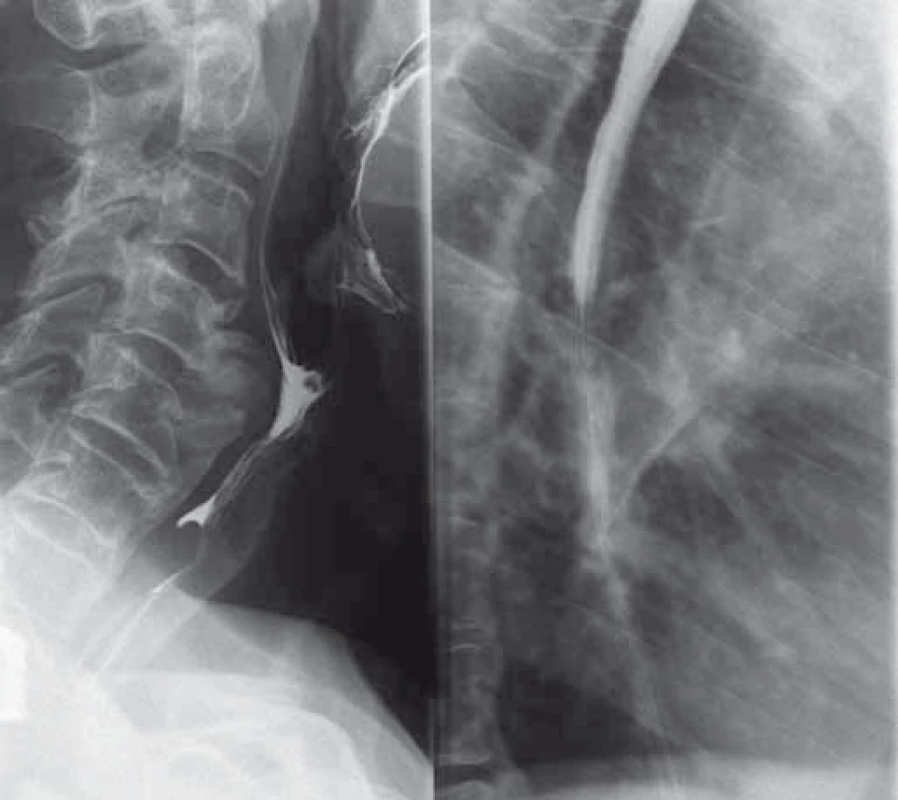 Polykací akt a RTG jícnu s nálezem přemosťujících osteofytů (kazuistika 1).
Fig. 1. The act of swallowing and oesophageal X-ray findings with bridging osteophytes (a case report 1).