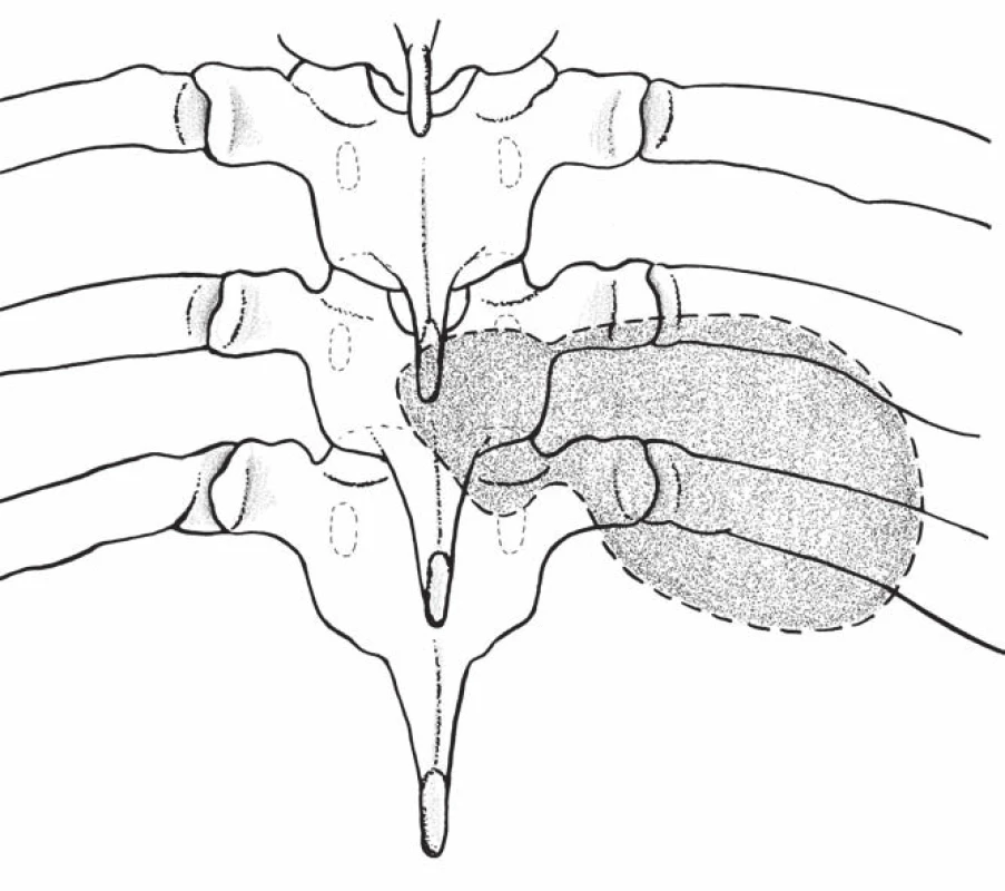 Nákres sutkovitého nádoru hrudní páteře (předozadní pohled).
Fig. 1. Drawing a dumbbell-shaped tumor of the thoracic spine (antero-posterior view).