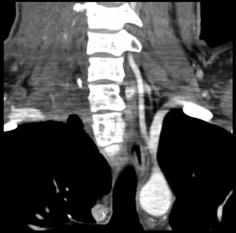 Pooperační CT angiografie
Stav po odstranění tumoru – koronární řez.