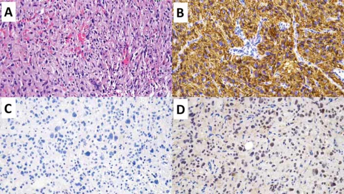 Polymorfní low-grade neuroepiteliální tumor mladistvých (PLNTY). Původní zvětšení 200×.