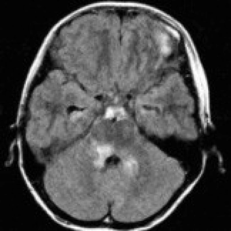 Biopticky verifikovaný low-grade astrocytom mozkového kmene na sekvenci FLAIR s asymetrickou hyperintenzitou v dorzálním pontu, infiltrující i horní mozečkový pedunkl.