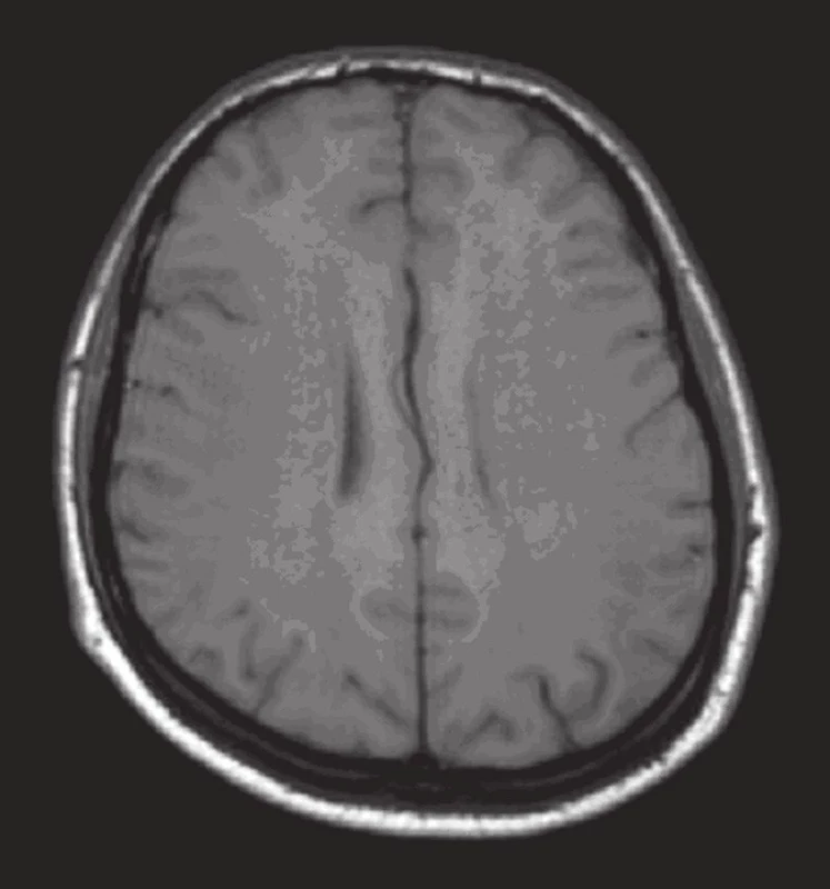 MR mozku: T1 vážený obraz transverzálně (tři dny po vzestupu TK): nepříliš výrazný nález plošného snížení signálu bílé hmoty hemisfér.
